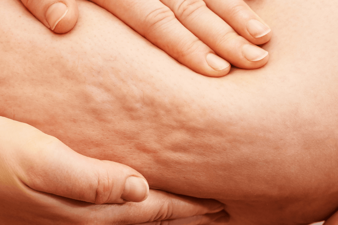 Let’s Talk Cellulite: From Normal to Nourished - SubLuna